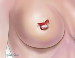 Nipple reconstruction surgery