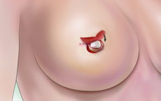 Nipple reconstruction surgery