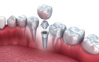 dental implant