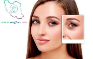 Eyelid_Surgery_in_Iran