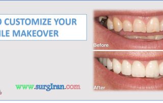 HOW TO CUSTOMIZE YOUR SMILE MAKEOVER