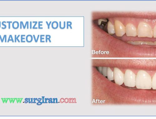How to customize your smile makeover