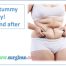 tummy tuck surgery