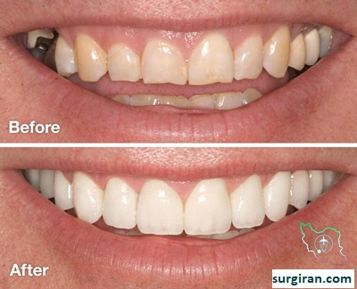 HOW TO CUSTOMIZE YOUR SMILE MAKEOVER