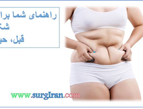 راهنمای شما برای جراحی زیبایی شکم – قبل، حین و بعد